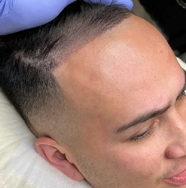 Men Hairline