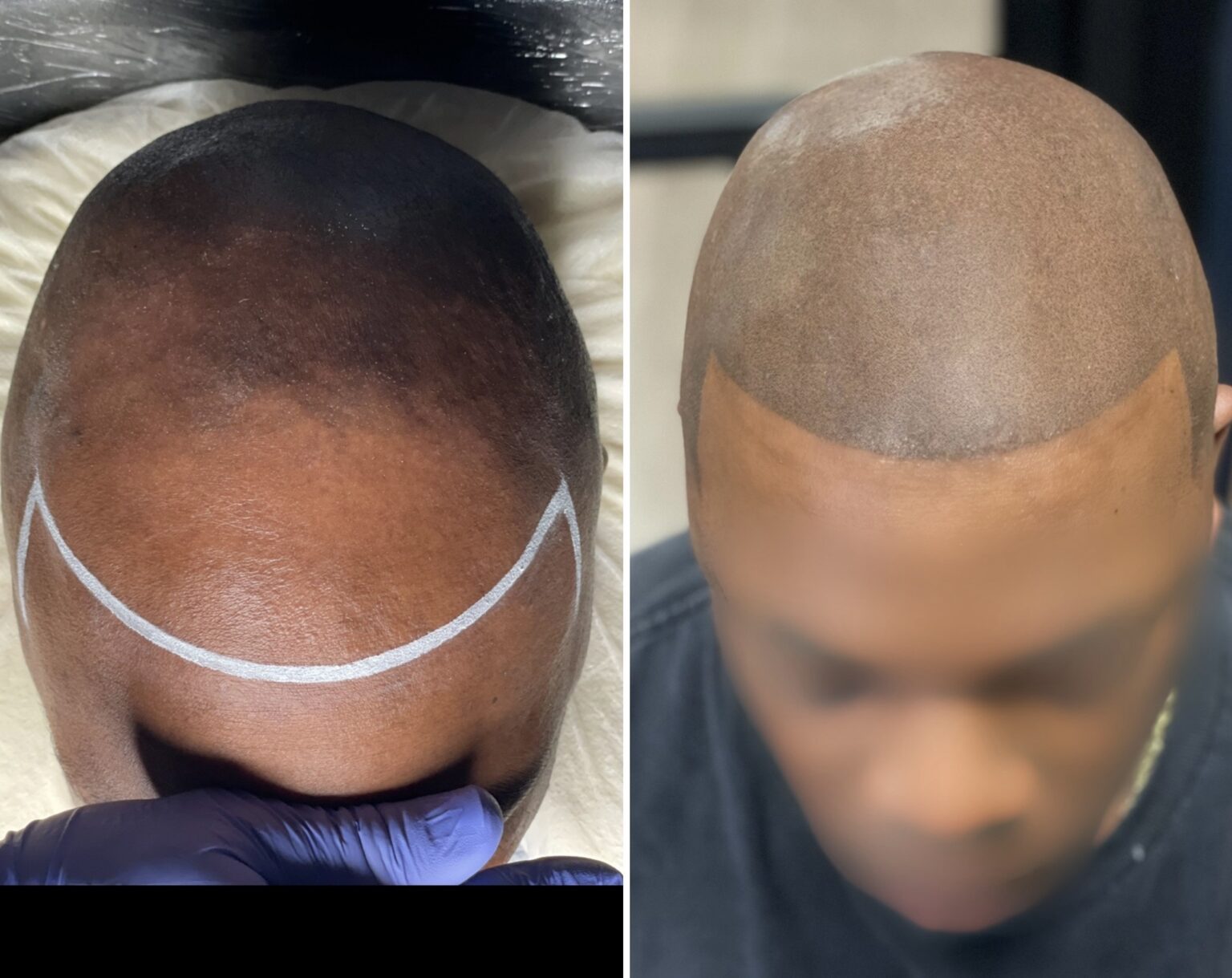 About - Scalp Micropigmentation for Scars - SMP for Scars - Scalp Micro pigmentation for Scaring
