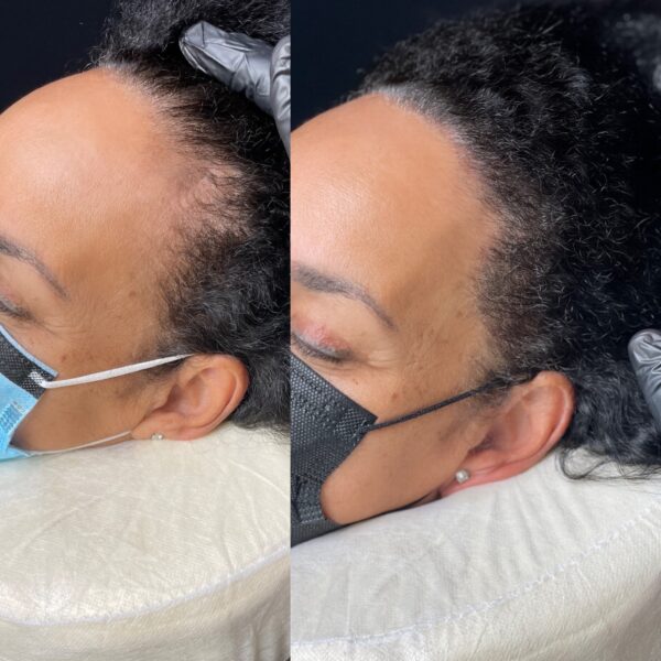 Women Hairline