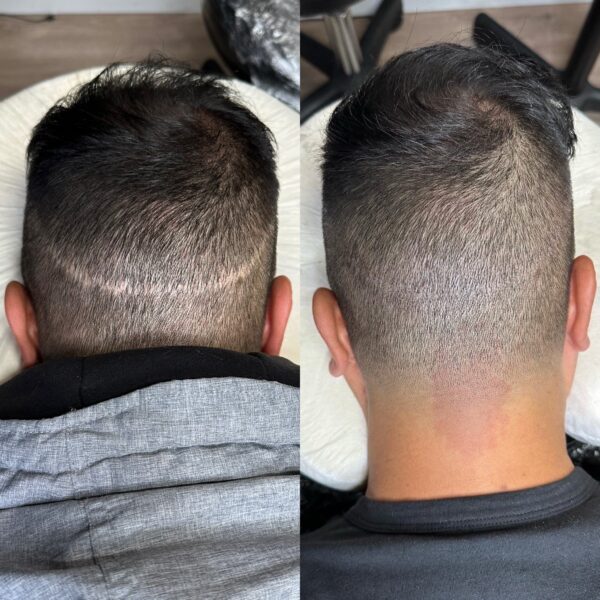Scar Cover ups